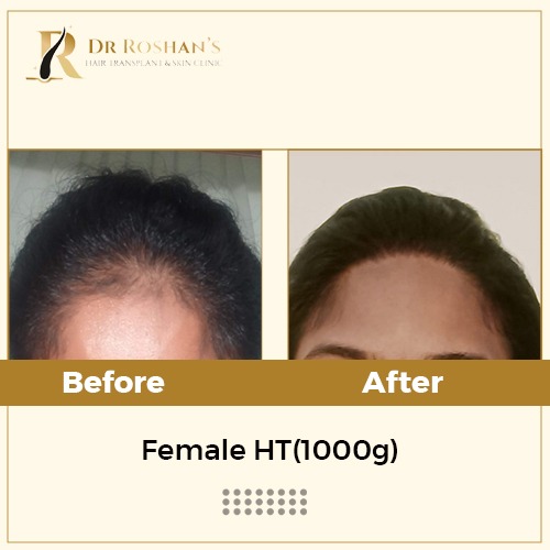 Hair Transplant in Bangalore