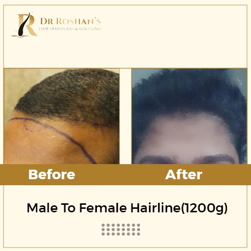 Hair Transplant in Bangalore