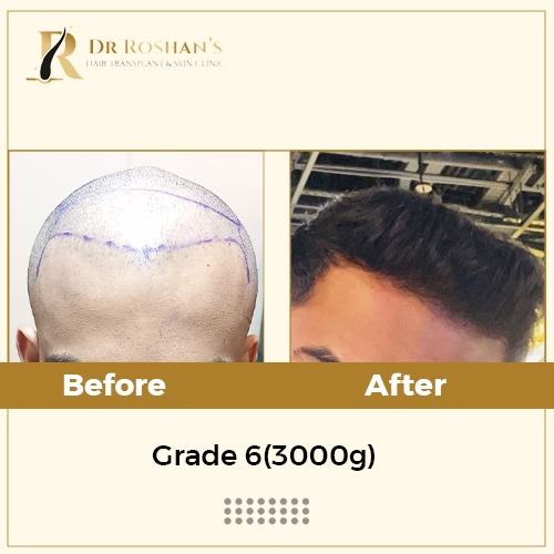 Hair Transplant in Bangalore