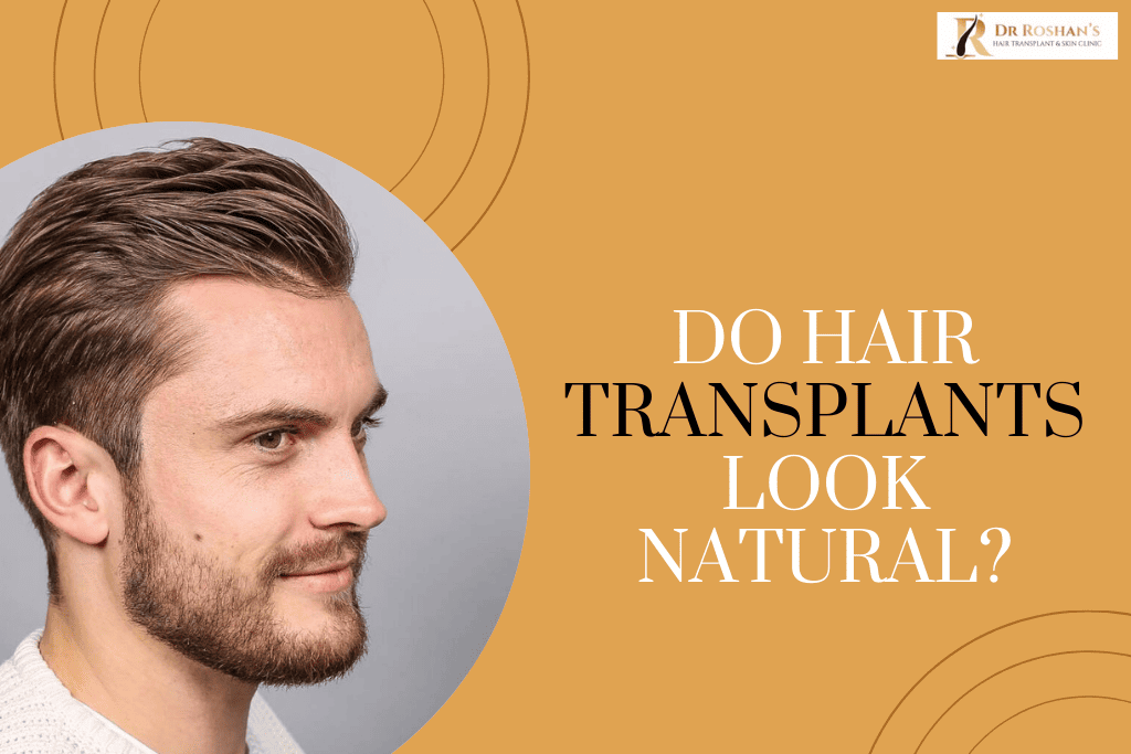 Do Hair Transplants Look Natural