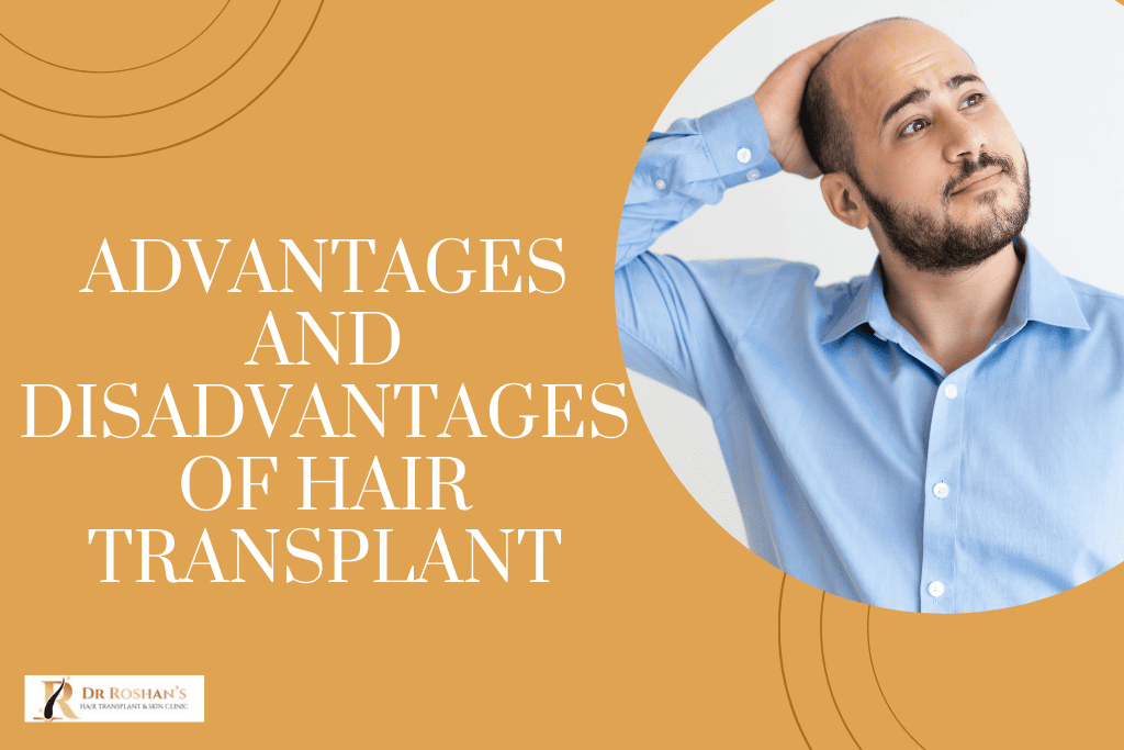 Advantages and Disadvantages of Hair Transplant