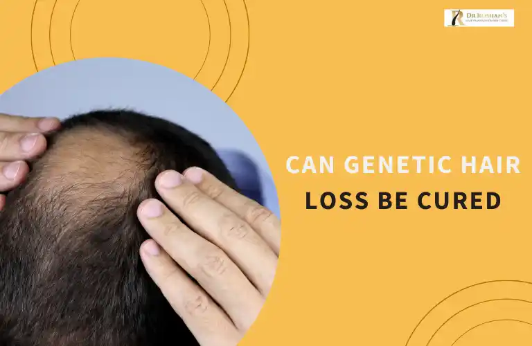 Can Genetic Hair Loss Be Cured