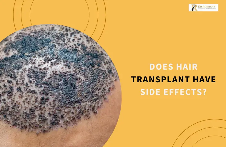 Does Hair Transplant Have Side Effects