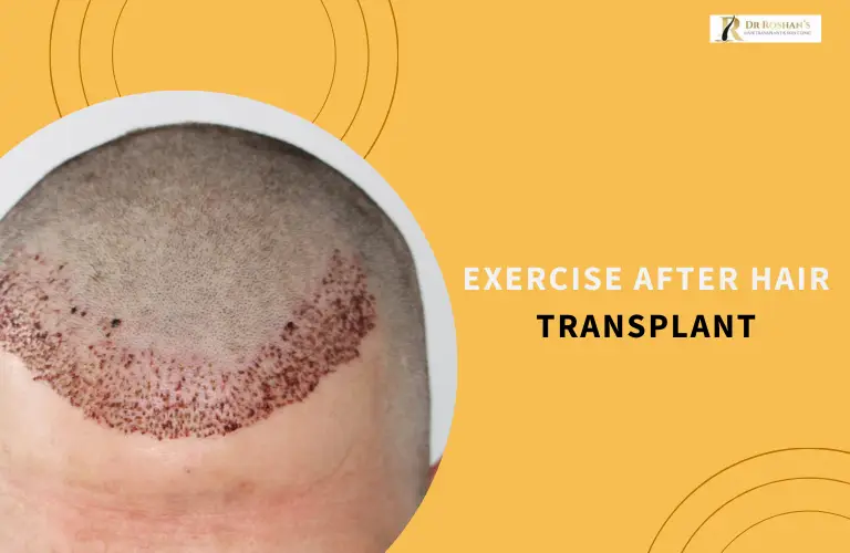 Exercise After Hair Transplant