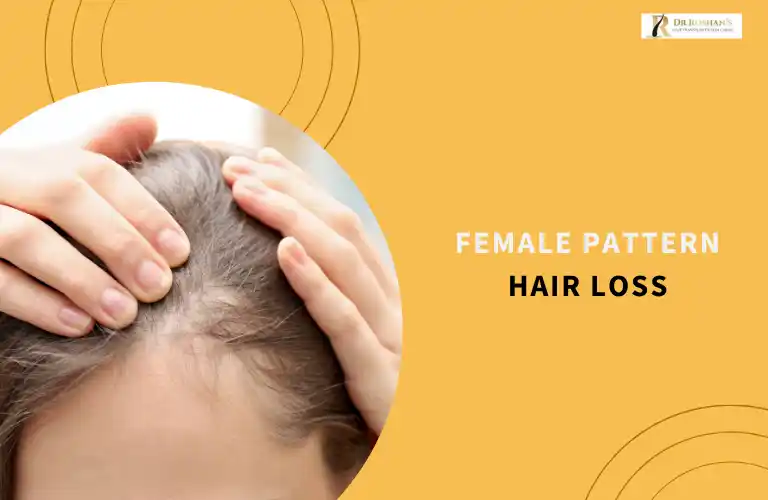 Female Pattern Hair Loss