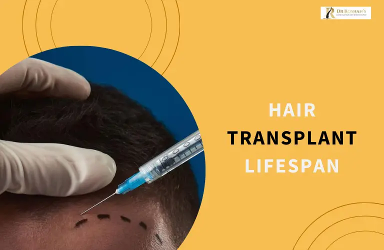 Hair Transplant Lifespan