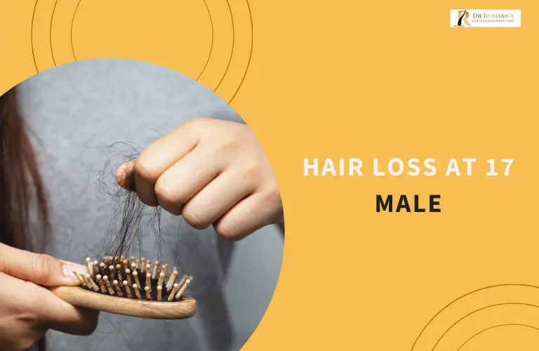 Hair Loss at 17 Male