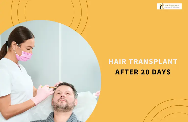 Hair Transplant After 20 Days
