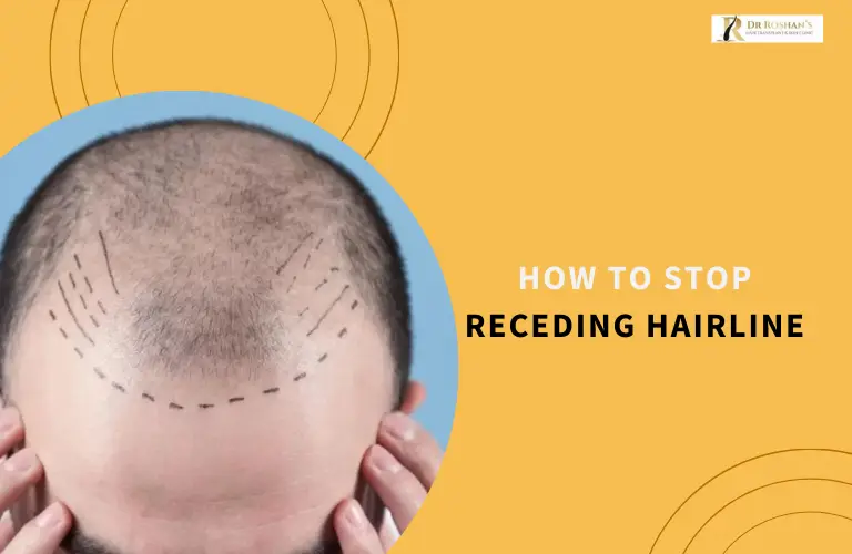 How to Stop Receding Hairline