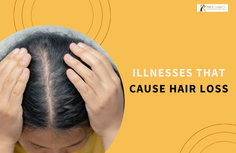 Illnesses That Cause Hair Loss