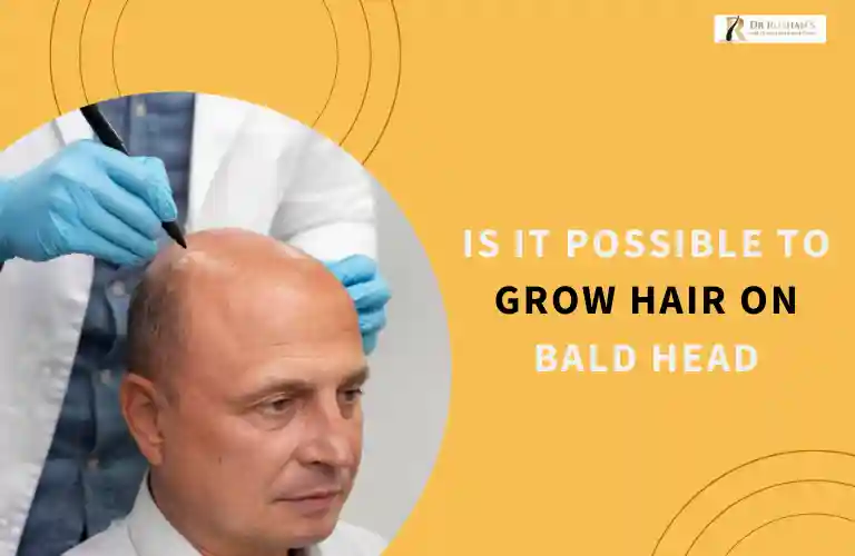 Is It Possible to Grow Hair on Bald Head