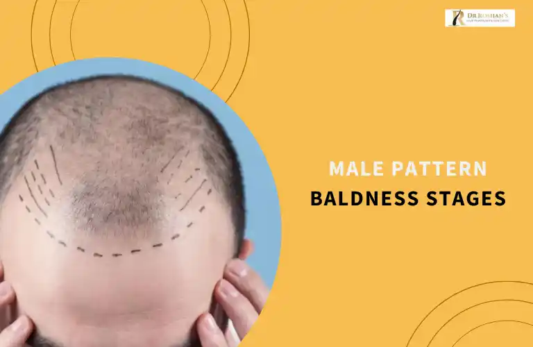 Male Pattern Baldness Stages