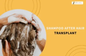Shampoo After Hair Transplant