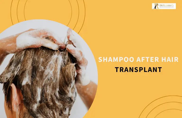 Shampoo After Hair Transplant