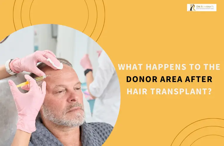 What Happens to the Donor Area After Hair Transplant