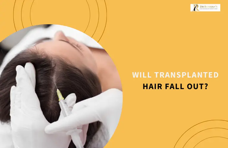 Will Transplanted Hair Fall Out