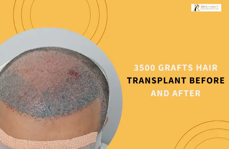3500 Grafts Hair Transplant Before After