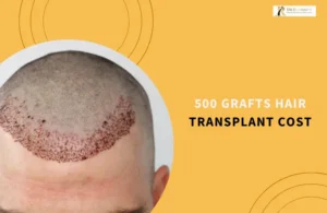 500 Grafts Hair Transplant Cost