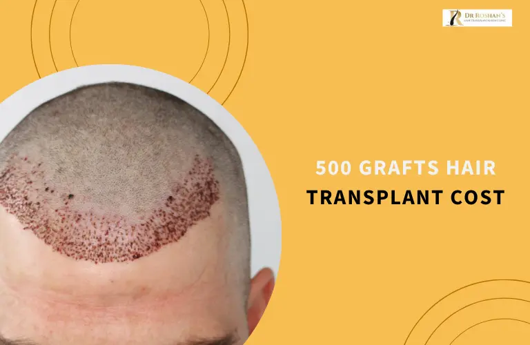 500 Grafts Hair Transplant Cost