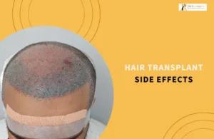 Hair Transplant Side Effects