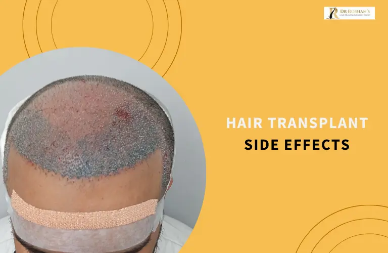 Hair Transplant Side Effects