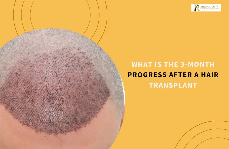 What Is the 3-Month Progress After a Hair Transplant