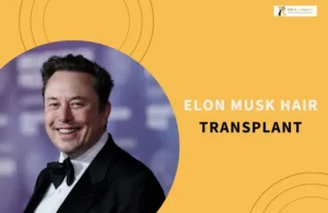 Elon Musk Hair Transplant