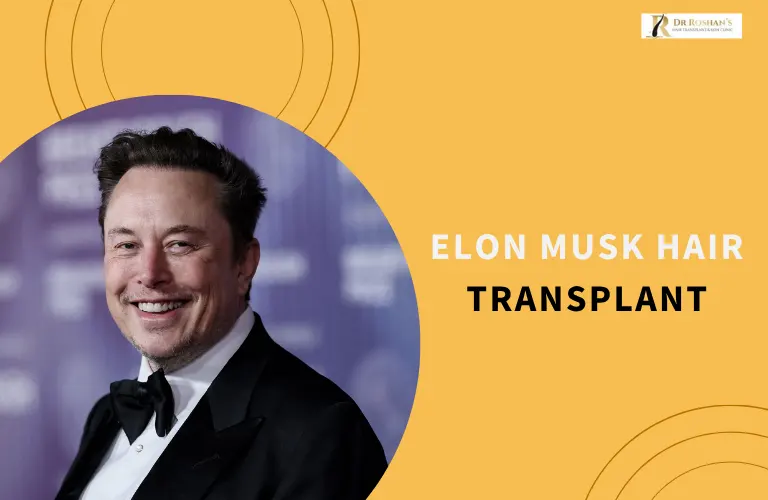 Elon Musk Hair Transplant