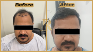 30% OFF Hair Transplant Before and After Results | Dr. Roshan Hair Transplant Clinic Bangalore